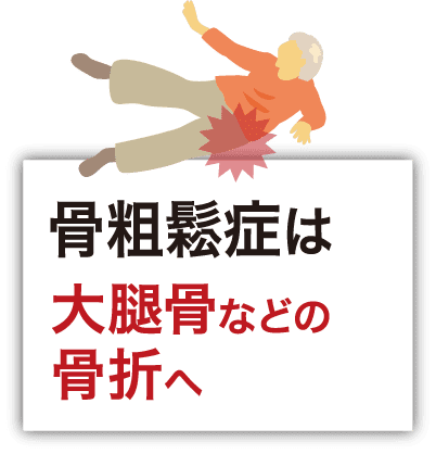 骨粗鬆症は大腿骨などの骨折へ